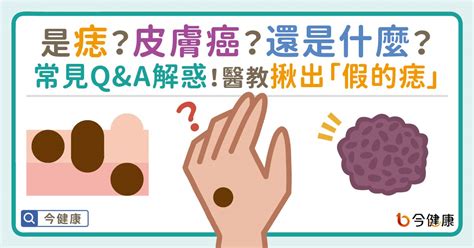 長毛的痣|是痣？皮膚癌？還是什麼？常見Q&A解惑！醫教揪出「。